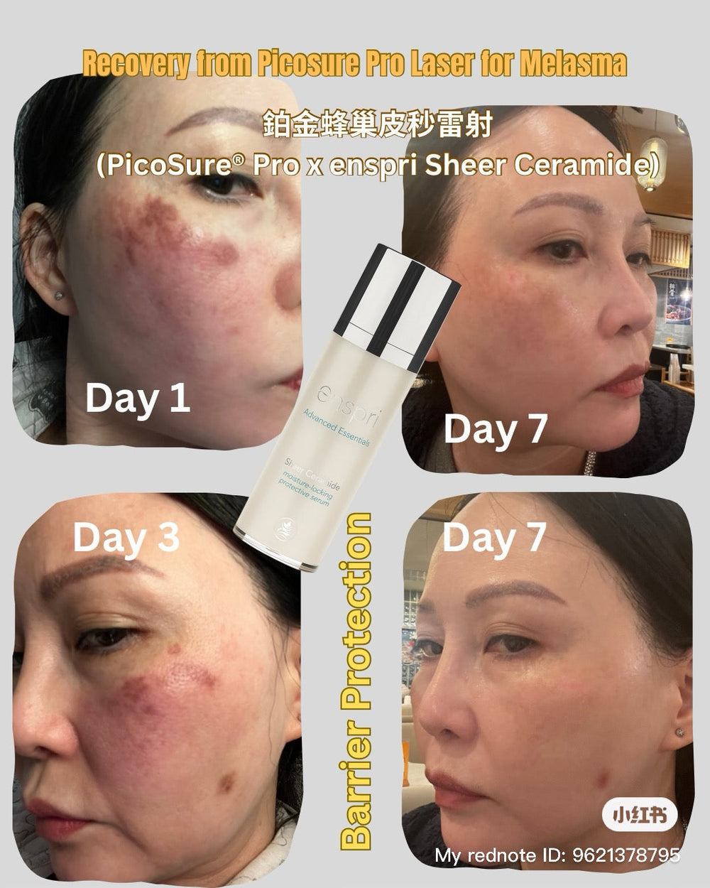 A 7-day recovery transformation collage from PicoSure Pro Laser for Melasma treatment. The photos show significant skin healing and barrier protection from Day 1 to Day 7 using Enspri Sheer Ceramide to calm redness and restore a luminous complexion.