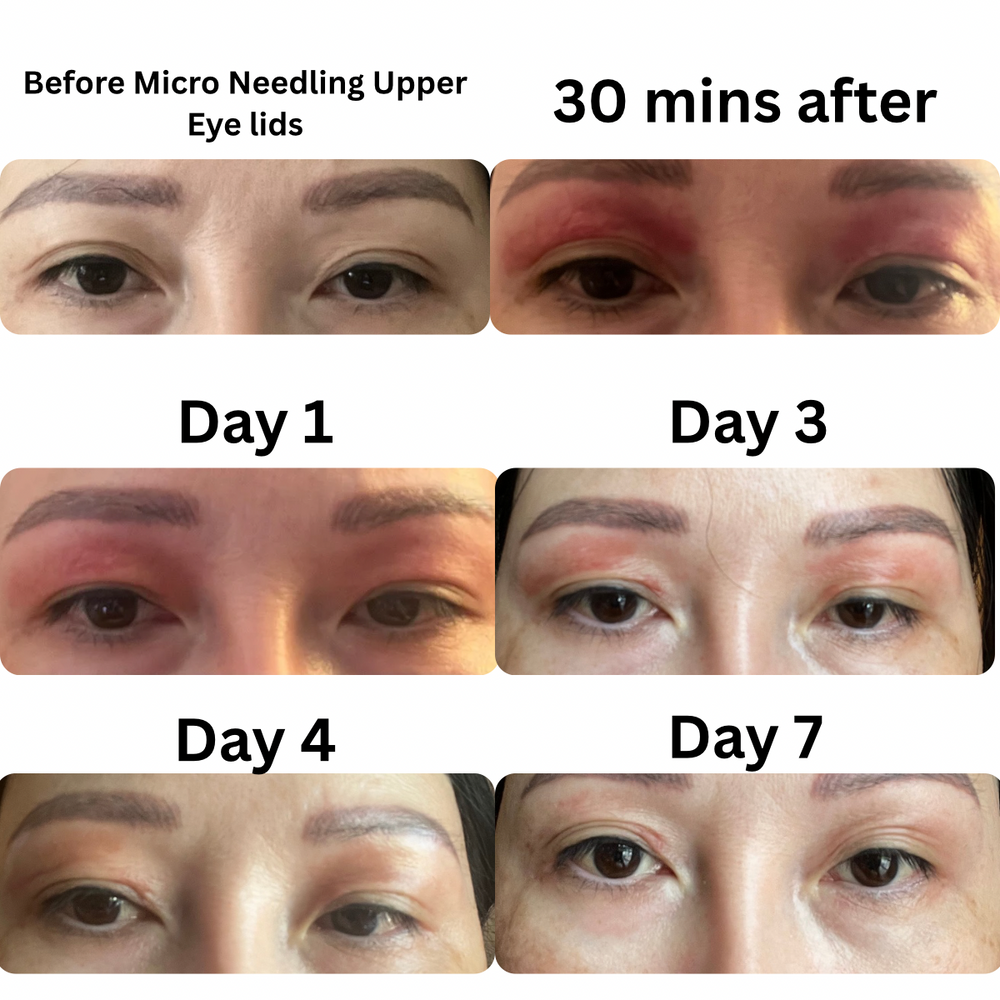  6 panel progression timeline image named Before Micro Needling.jpg showing the 7-day healing and recovery process of upper eyelid microneedling, moving from initial drooping and post-treatment redness to a visibly firmer and refreshed eye area by Day 7.