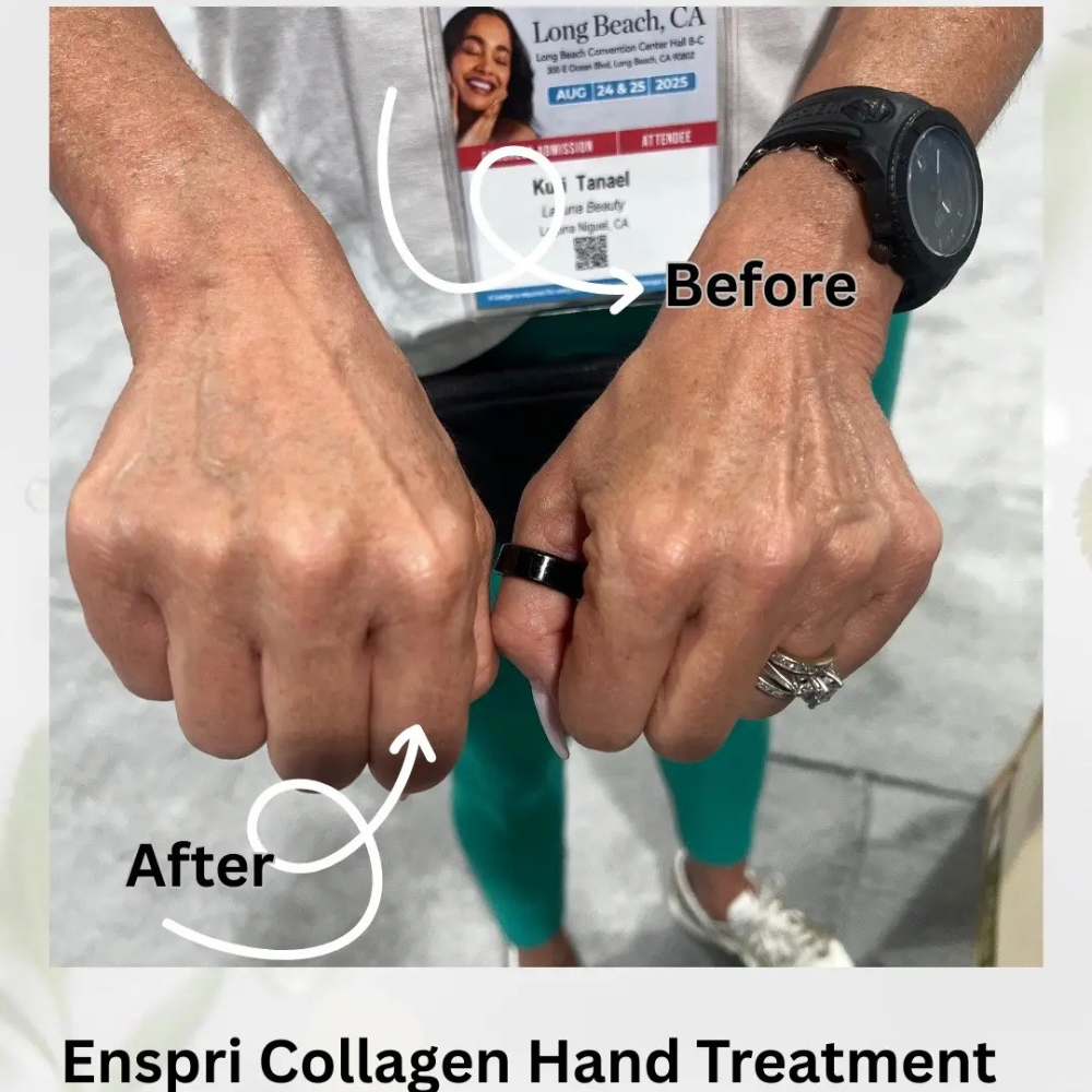 Before and After Enspri Collagen Hand Treatment