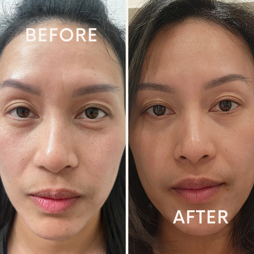 Close-up of glowing skin after professional microneedling treatment - Enspri Skincare Recovery Guide.
