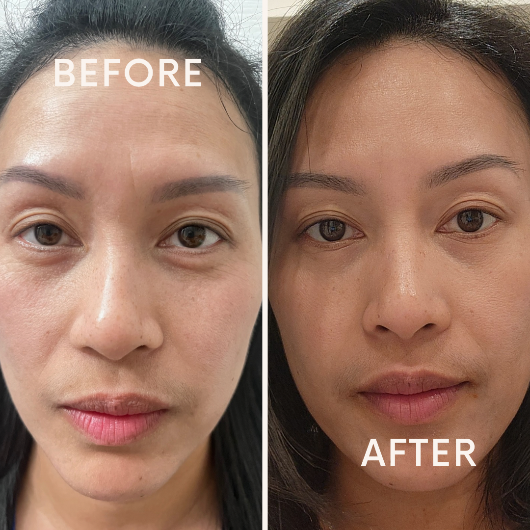 Before and after comparison of a microneedling treatment results using Enspri Peptide Plus Serum. The 'Before' photo shows fine lines and uneven texture, while the 'After' photo demonstrates significantly smoother, firmer, and more hydrated skin.
