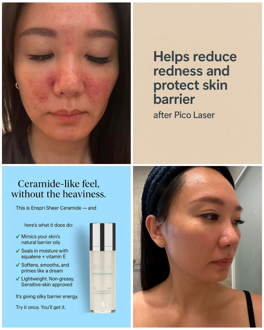 Restoring sensitive, redness-prone skin after laser with Enspri Sheer Ceramide.