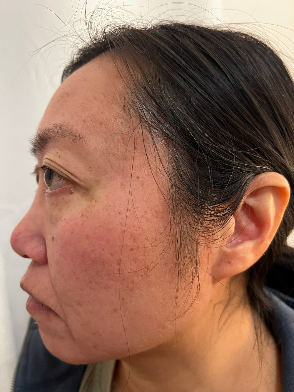 Side profile close-up of a client's cheek showing uneven skin texture, post-blemish scarring, and mild hyperpigmentation before an Enspri microneedling recovery treatment.