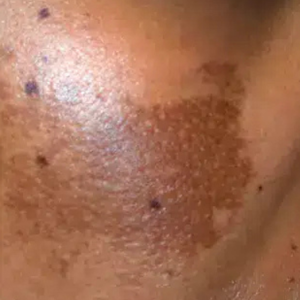 A close-up view of the cheek area showing melasma, characterized by a large, irregular dark brown patch of pigmented skin that has clustered together into a distinct shape against a lighter skin tone.