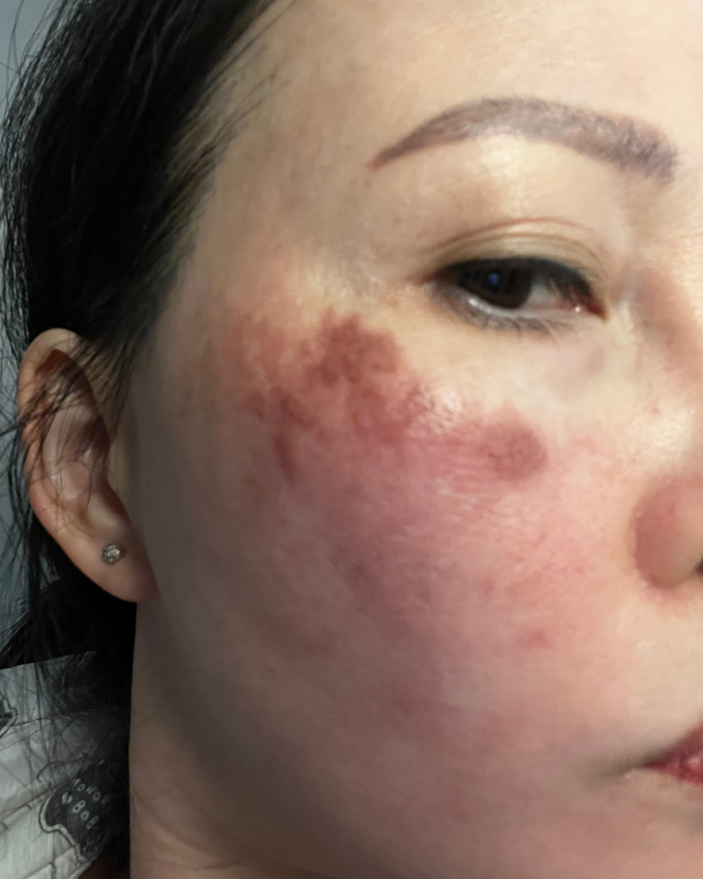 Close-up of a person's cheek showing immediate post-laser skin reaction, featuring distinct dark, textured scabbing and surrounding erythema or redness following a PicoSure Pro laser treatment.