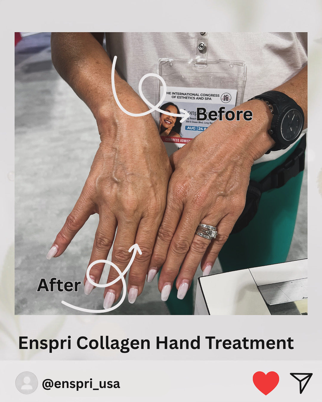 Instant hand rejuvenation results using Enspri Ultra Collagen Mask at ICES Long Beach. The 'After' hand shows visible skin tightening, reduced fine lines, and a brighter, hydrated texture compared to the 'Before' hand.