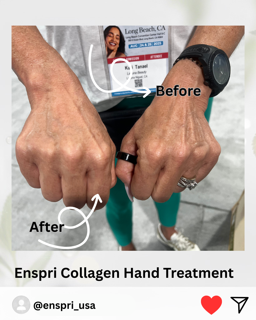 Clinical demo of Enspri Ultra Collagen Mask showing immediate tightening effects on the hands. The treatment visibly smooths crepey skin and plumps the appearance of the dorsal hand for a youthful, firm look.