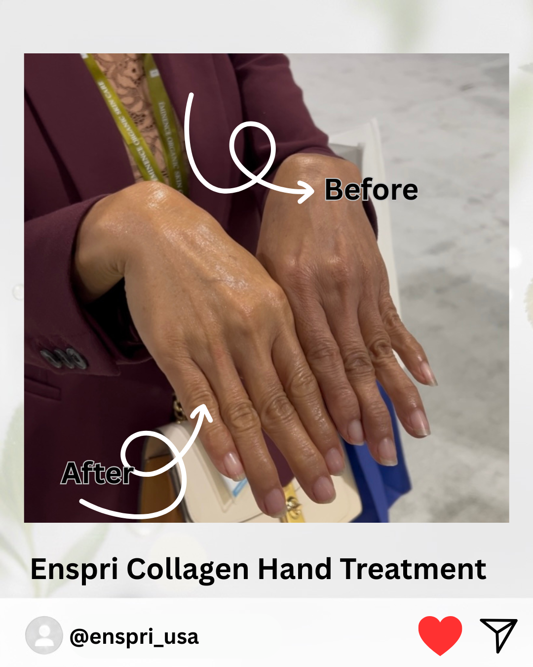 Professional hand-lift transformation using Enspri 5-minute Collagen treatment. Side-by-side comparison shows the 'After' hand with significantly improved skin elasticity, reduced sun-damage appearance, and a revitalized glow.