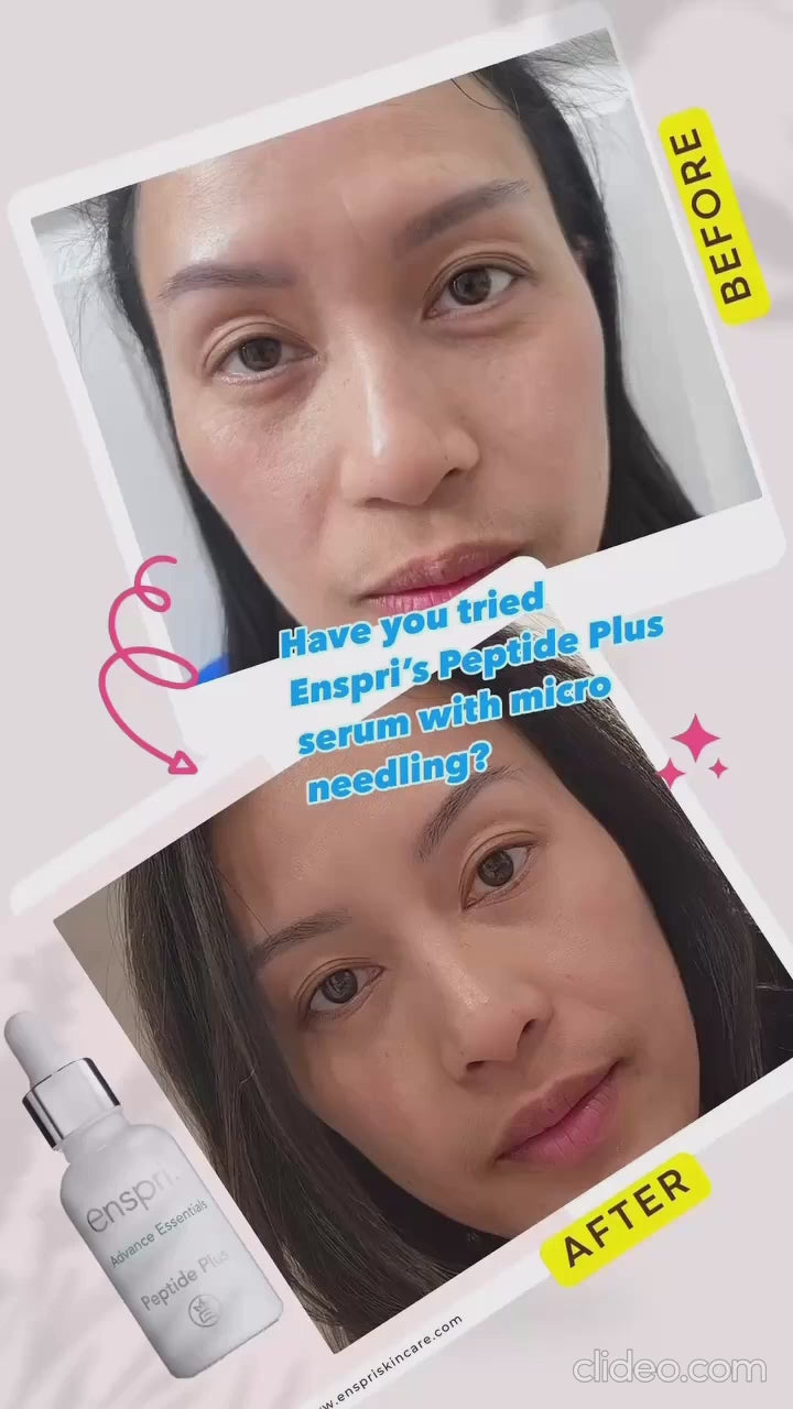 enspri-peptide-plus-microneedling-before-and-after-results-Video